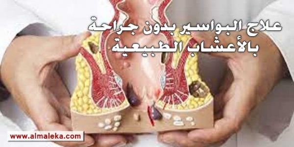 علاج البواسير بدون جراحة بالأعشاب الطبيعية