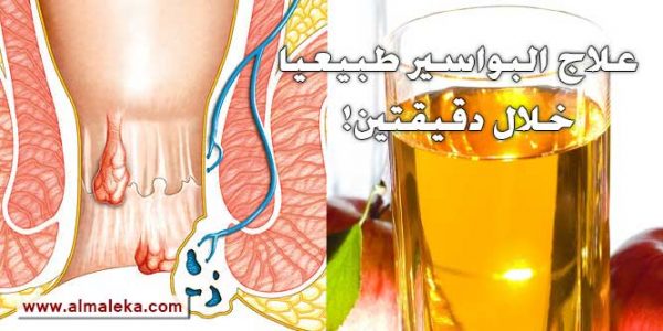 علاج البواسير الخارجية بخل التفاح خلال دقيقتين