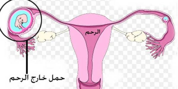 الحمل خارج الرحم