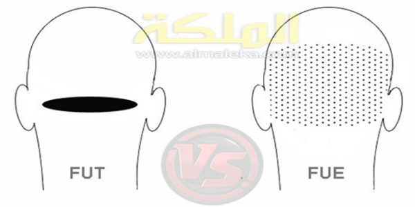 زراعة-الشعر-بالاقتطاف-والشريحة