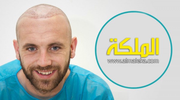 بعد شهر من إجراء عملية زراعة الشعر