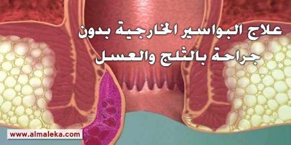 أسباب وعلاج البواسير الخارجية بدون جراحة بالثلج والعسل
