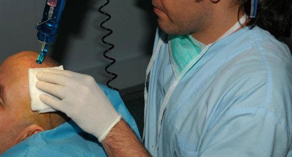 ما هى اضرار زراعة الشعر؟