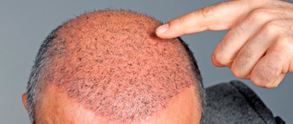 عملية زراعة الشعر